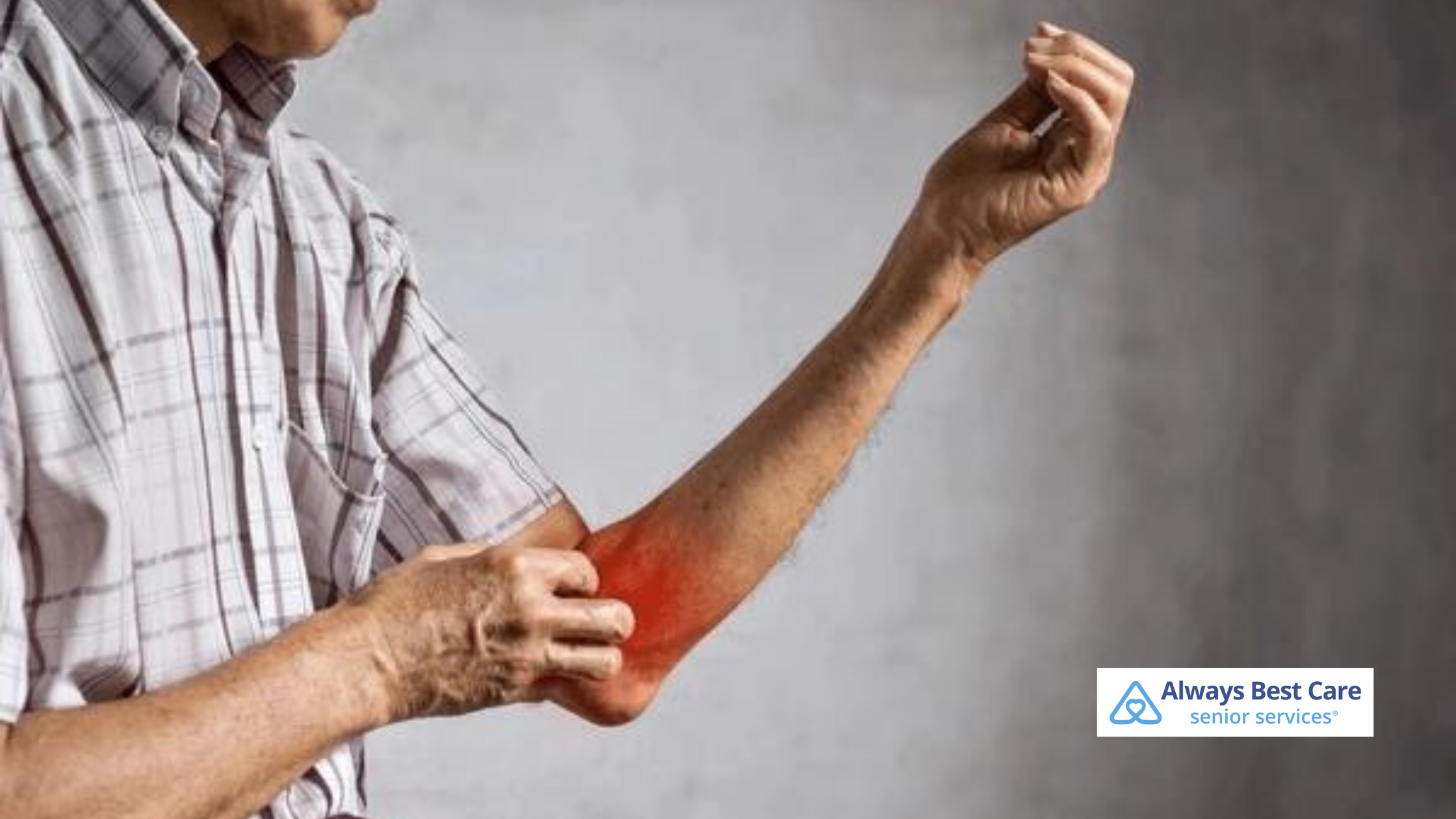 Managing Psoriasis Flare-Ups: Tips for Seniors