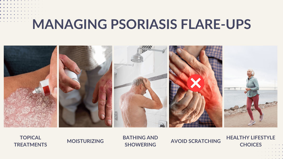 managing psoriasis flare-ups