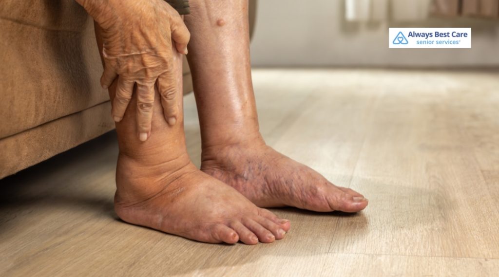 A senior person with visibly swollen feet and ankles sits on the edge of a sofa, with hands resting on one ankle. 