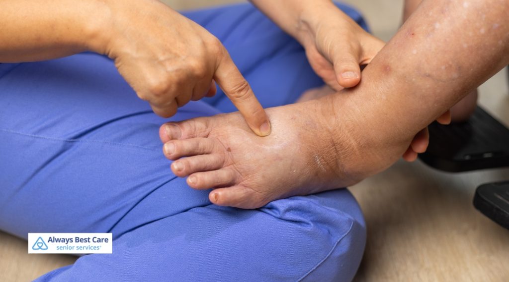 A caregiver in blue scrubs uses their finger to gently press and assess a swollen area on a senior's foot and ankle, indicating medical evaluation or monitoring for edema.