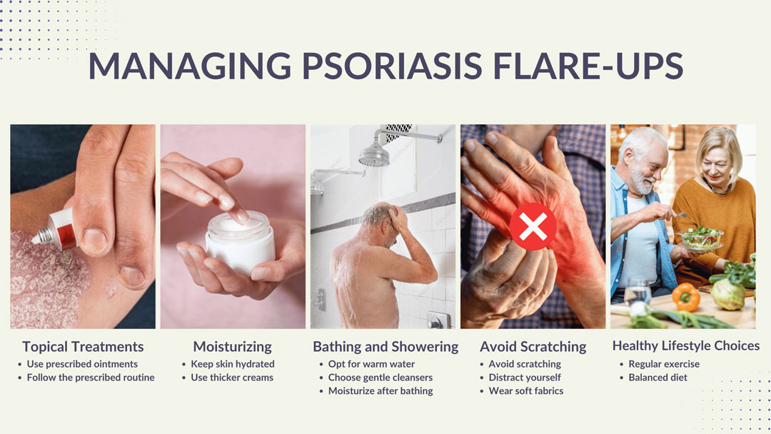 Managing Psoriasis flare-ups