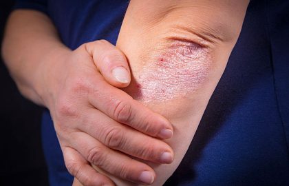 Managing Psoriasis Flare-Ups: Tips for Seniors