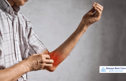 Managing Psoriasis Flare-Ups: Tips for Seniors