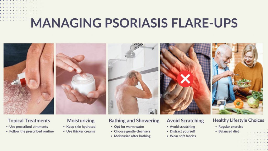 managing psoriasis