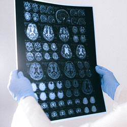 UNDERSTANDING THE PROGRESSION OF ALZHEIMER’S DISEASE 3 UNDERSTANDING THE PROGRESSION OF ALZHEIMER’S DISEASE