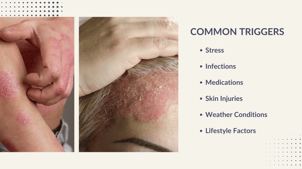 COMMON TRIGGERS FOR PSORIASIS FLARE UPS