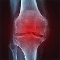 KEEPING WINTER JOINT PAIN IN CHECK