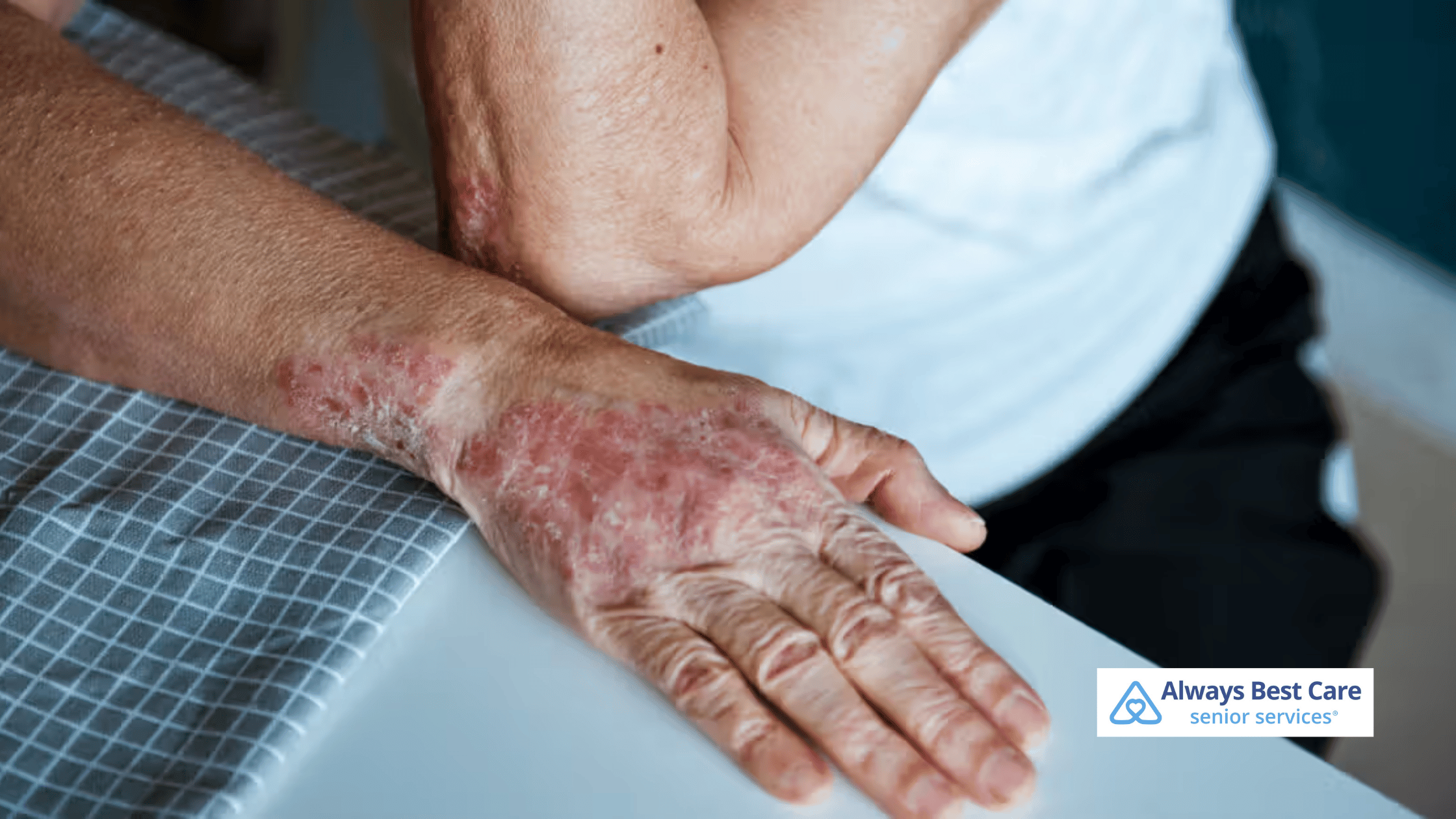 MANAGING PSORIASIS FLARE-UPS: TIPS FOR SENIORS