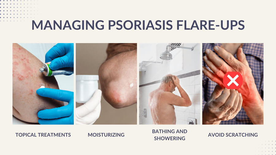 managing psoriasis