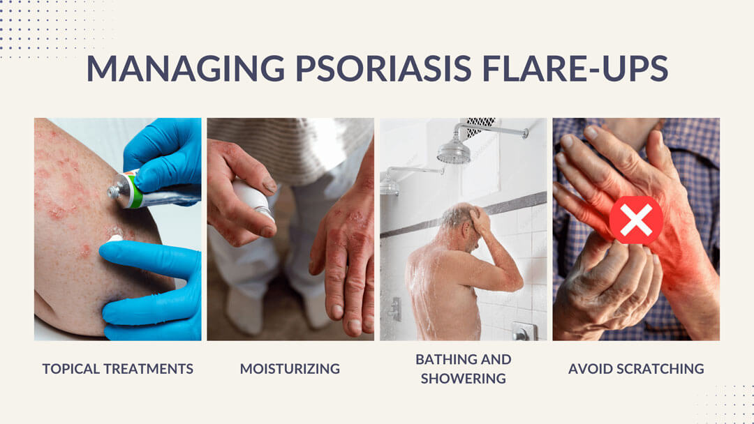 managing psoriasis