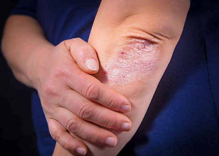 Managing Psoriasis Flare-Ups: Tips for Seniors