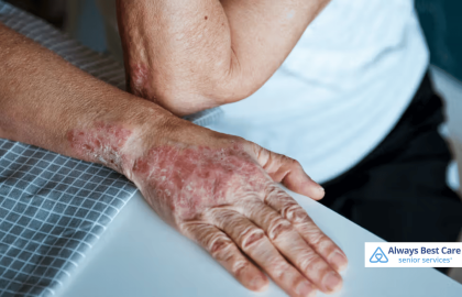 Managing Psoriasis Flare-Ups: Tips for Seniors