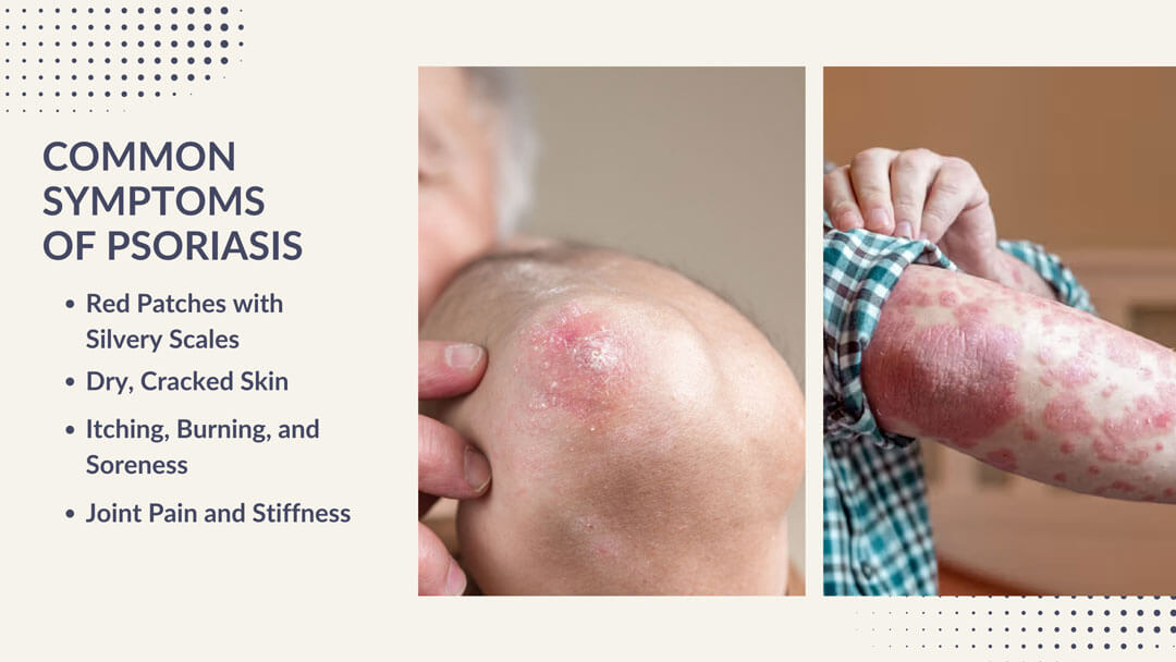 common symptoms and psoriasis