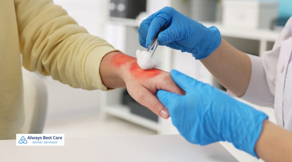 Healthcare professional wearing blue gloves using forceps and a cotton swab to treat an irritated wound on a patient's hand in a clinical setting.