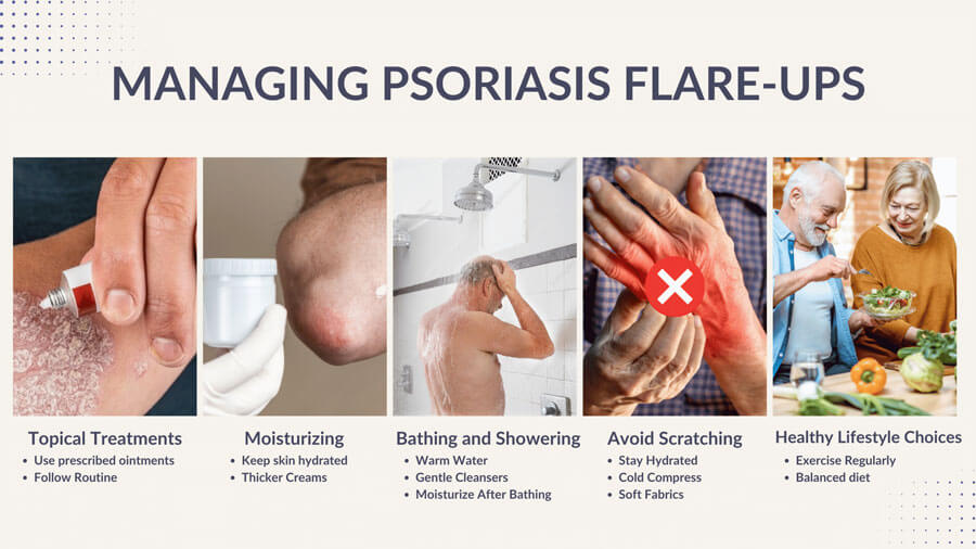 Managing-Psoriasis-Flare-Ups tips