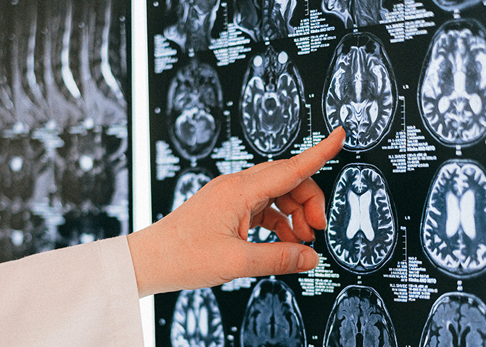 Impacts of Brain Injury On Seniors
