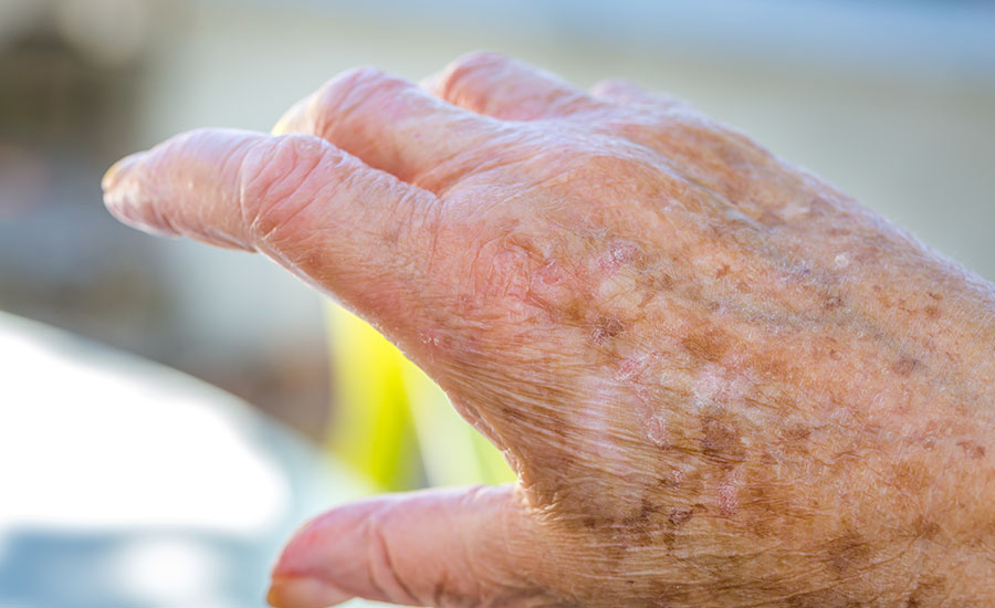 An elderly hand with liver spots​