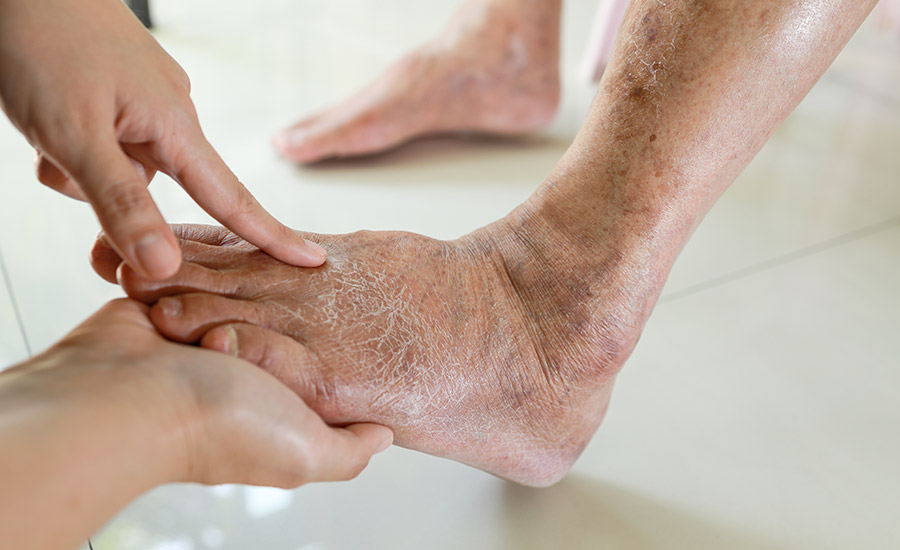 An elderly patient's dry foot​