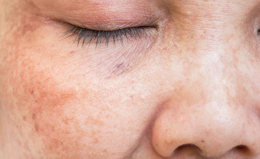 A senior's face with liver spots​